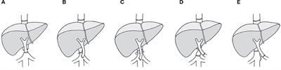 A novel approach for portal system reconstruction in liver transplant patients with grade IV portal vein thrombosis: Case study and literature review